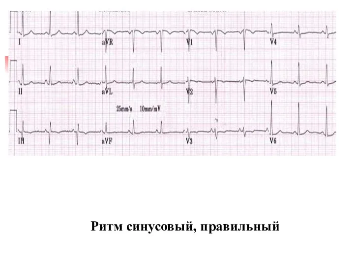 Ритм синусовый, правильный