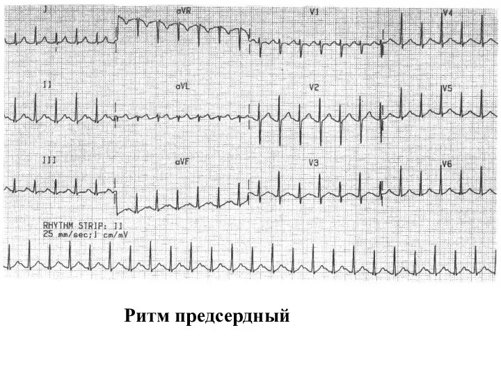 Ритм предсердный