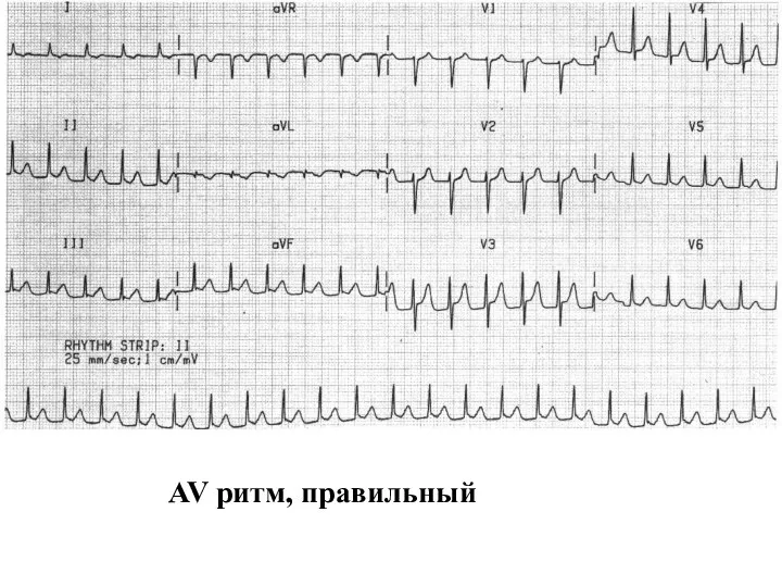 AV ритм, правильный