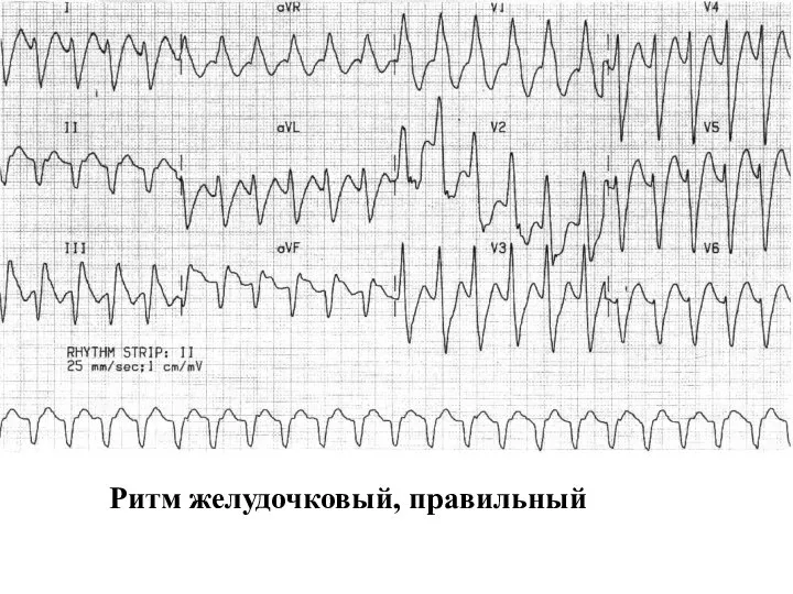 Ритм желудочковый, правильный