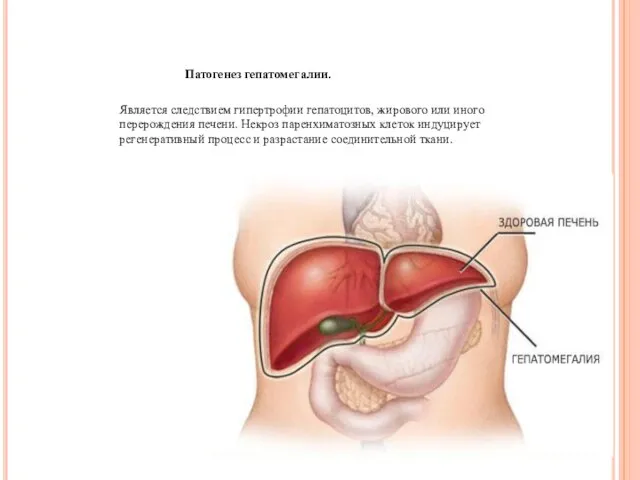 Патогенез гепатомегалии. Является следствием гипертрофии гепатоцитов, жирового или иного перерождения печени.