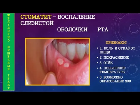 СТОМАТИТ – ВОСПАЛЕНИЕ СЛИЗИСТОЙ ОБОЛОЧКИ РТА ПРИЗНАКИ: 1. БОЛЬ И ОТКАЗ