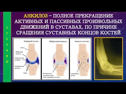 АНКИЛОЗ – ПОЛНОЕ ПРЕКРАЩЕНИЕ АКТИВНЫХ И ПАССИВНЫХ ПРОИЗВОЛЬНЫХ ДВИЖЕНИЙ В СУСТАВАХ,