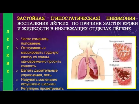 ЗАСТОЙНАЯ (ГИПОСТАТИЧЕСКАЯ) ПНЕВМОНИЯ-ВОСПАЛЕНИЕ ЛЁГКИХ ПО ПРИЧИНЕ ЗАСТОЯ КРОВИ И ЖИДКОСТИ В