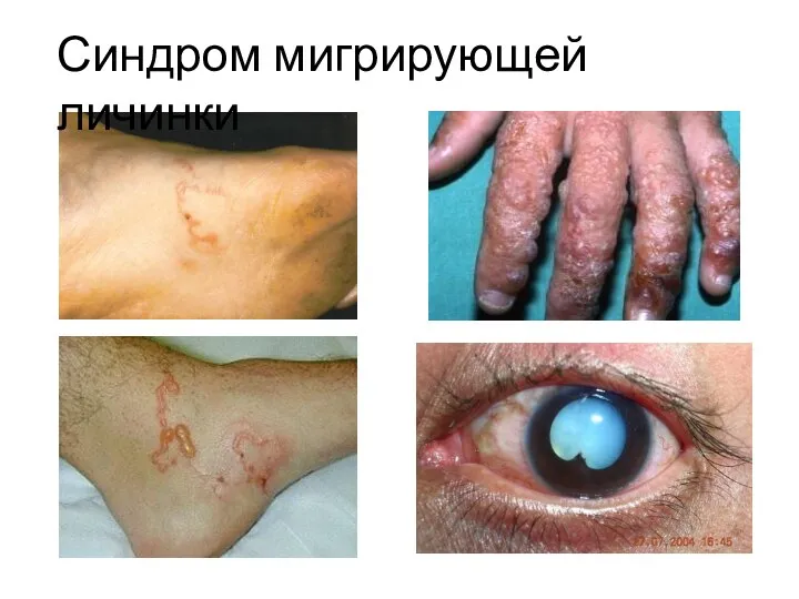 Синдром мигрирующей личинки