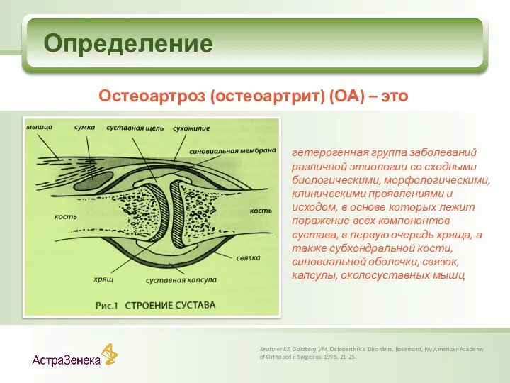 Определение Остеоартроз (остеоартрит) (ОА) – это Keuttner KE, Goldberg VM. Osteoarthritis