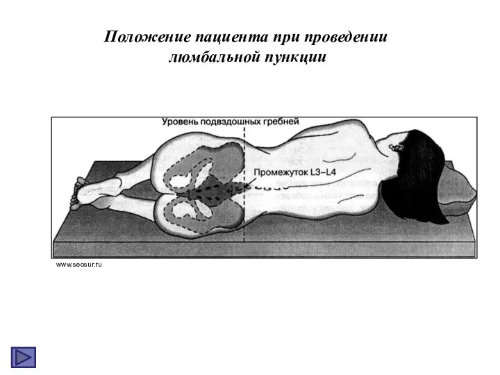 www.seosur.ru Положение пациента при проведении люмбальной пункции
