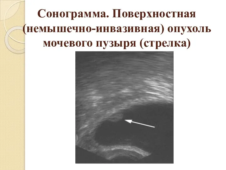 Сонограмма. Поверхностная (немышечно-инвазивная) опухоль мочевого пузыря (стрелка)