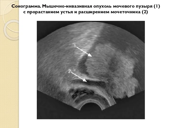 Сонограмма. Мышечно-инвазивная опухоль мочевого пузыря (1) с прорастанием устья и расширением мочеточника (2)