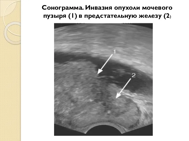 Сонограмма. Инвазия опухоли мочевого пузыря (1) в предстательную железу (2)