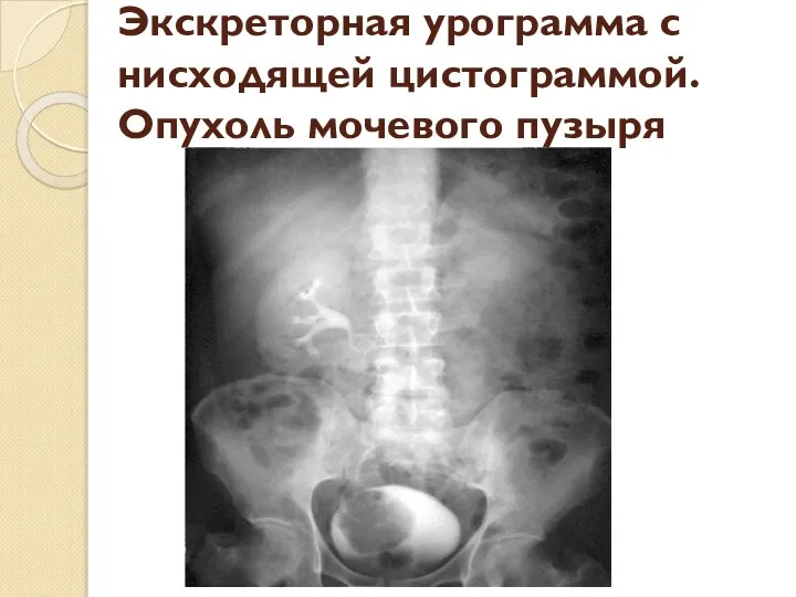 Экскреторная урограмма с нисходящей цистограммой. Опухоль мочевого пузыря