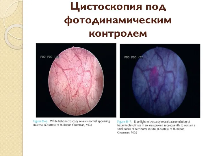 Цистоскопия под фотодинамическим контролем