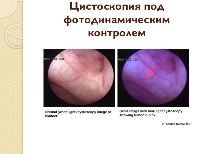 Цистоскопия под фотодинамическим контролем