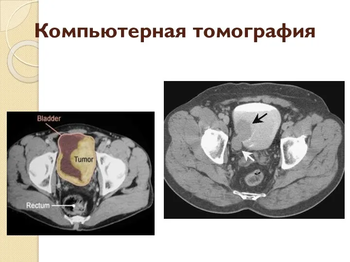 Компьютерная томография