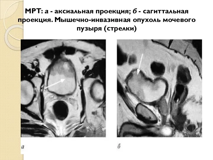 МРТ: а - аксиальная проекция; б - сагиттальная проекция. Мышечно-инвазивная опухоль мочевого пузыря (стрелки)