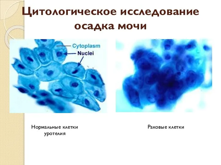 Цитологическое исследование осадка мочи Нормальные клетки уротелия Раковые клетки