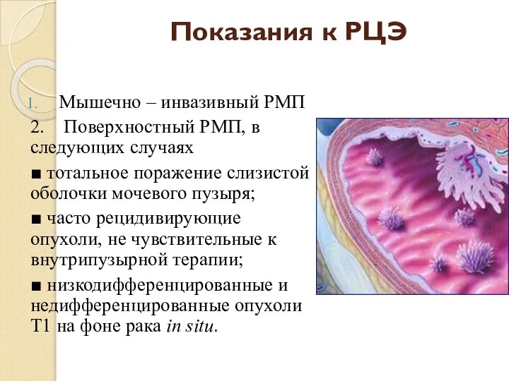 Показания к РЦЭ Мышечно – инвазивный РМП 2. Поверхностный РМП, в