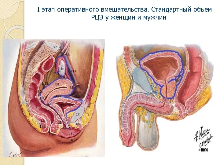 I этап оперативного вмешательства. Стандартный объем РЦЭ у женщин и мужчин