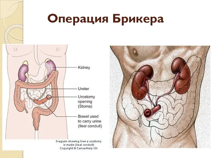 Операция Брикера