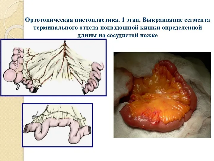 Ортотопическая цистопластика. 1 этап. Выкраивание сегмента терминального отдела подвздошной кишки определенной длины на сосудистой ножке