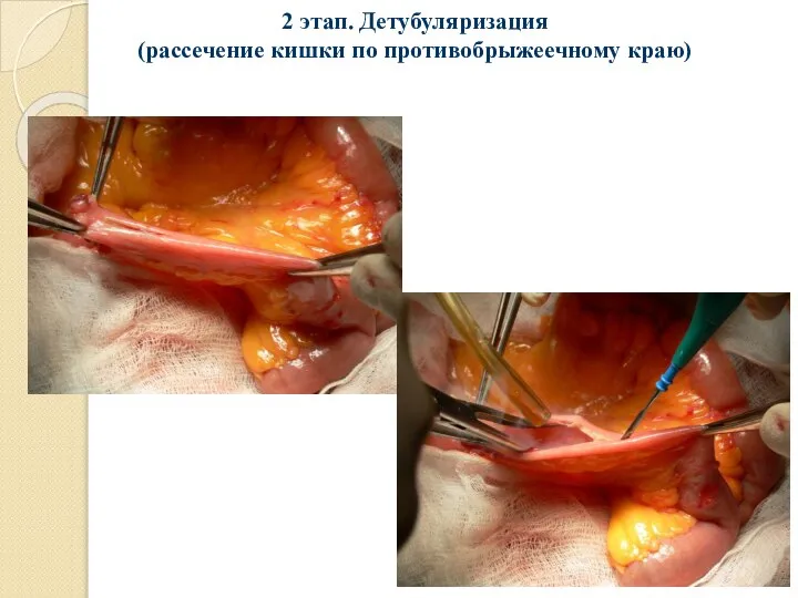 2 этап. Детубуляризация (рассечение кишки по противобрыжеечному краю)