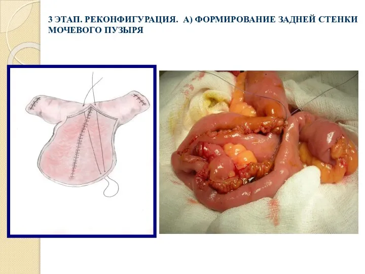 3 ЭТАП. РЕКОНФИГУРАЦИЯ. А) ФОРМИРОВАНИЕ ЗАДНЕЙ СТЕНКИ МОЧЕВОГО ПУЗЫРЯ