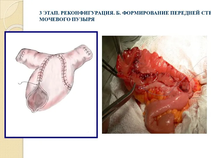 3 ЭТАП. РЕКОНФИГУРАЦИЯ. Б. ФОРМИРОВАНИЕ ПЕРЕДНЕЙ СТЕНКИ МОЧЕВОГО ПУЗЫРЯ