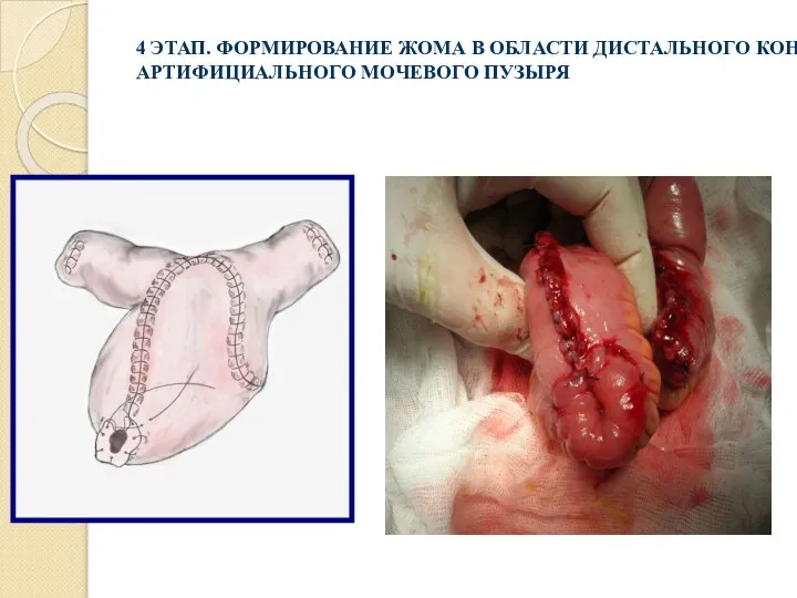 4 ЭТАП. ФОРМИРОВАНИЕ ЖОМА В ОБЛАСТИ ДИСТАЛЬНОГО КОНЦА АРТИФИЦИАЛЬНОГО МОЧЕВОГО ПУЗЫРЯ