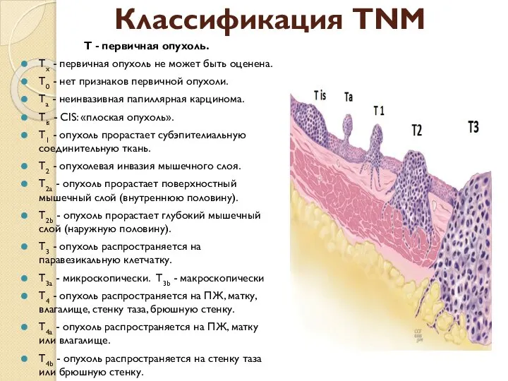 Классификация TNM Т - первичная опухоль. Тх - первичная опухоль не