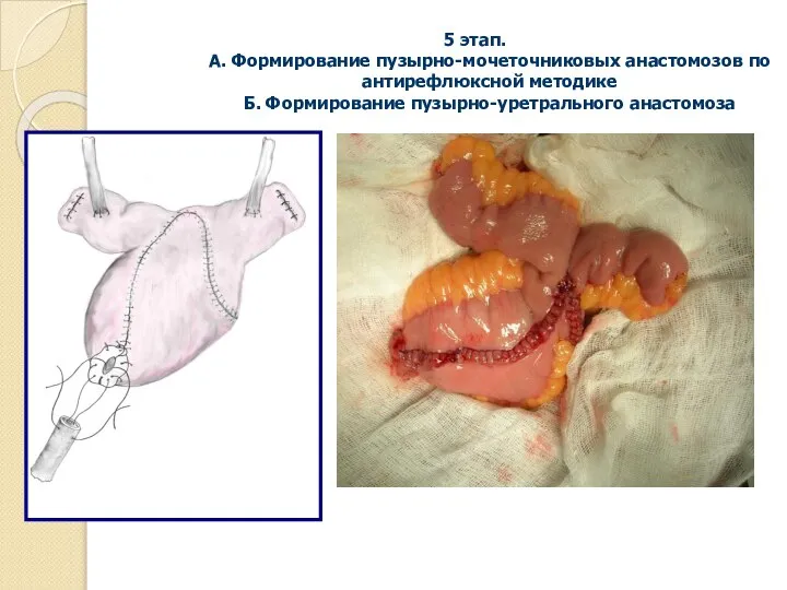 5 этап. А. Формирование пузырно-мочеточниковых анастомозов по антирефлюксной методике Б. Формирование пузырно-уретрального анастомоза