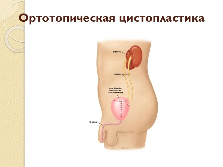 Ортотопическая цистопластика