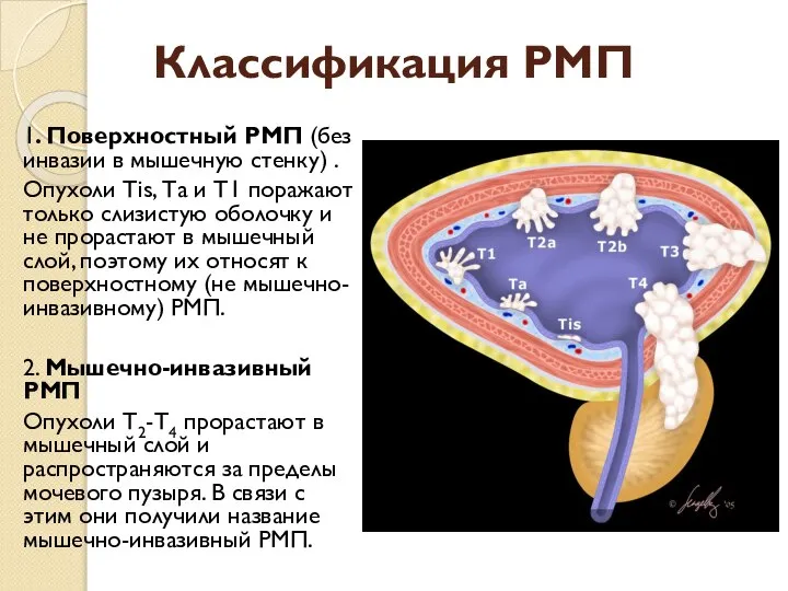 Классификация РМП 1. Поверхностный РМП (без инвазии в мышечную стенку) .