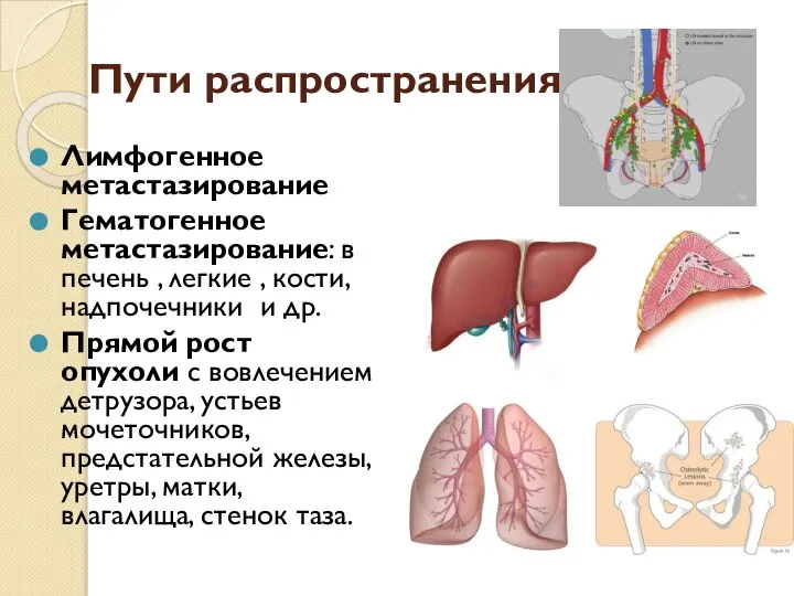 Пути распространения Лимфогенное метастазирование Гематогенное метастазирование: в печень , легкие ,