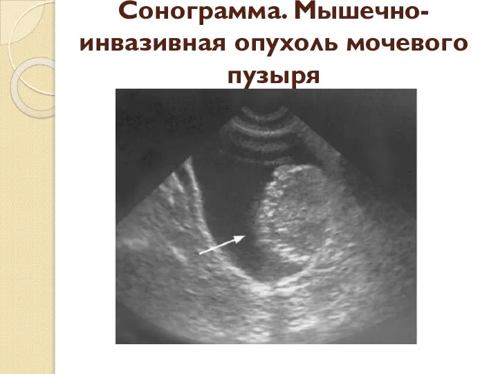 Сонограмма. Мышечно-инвазивная опухоль мочевого пузыря