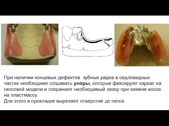 При наличии концевыx дефектов зубных рядов в седловидных частях необходимо создавать