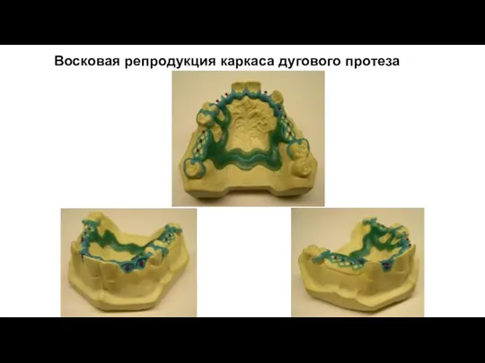 Восковая репродукция каркаса дугового протеза