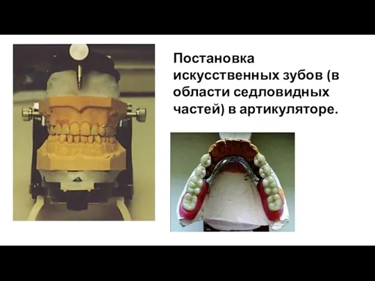 Постановка искусственных зубов (в области седловидных частей) в артикуляторе.