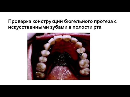 Проверка конструкции бюгельного протеза с искусственными зубами в полости рта