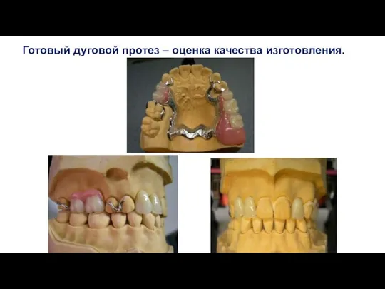 Готовый дуговой протез – оценка качества изготовления.