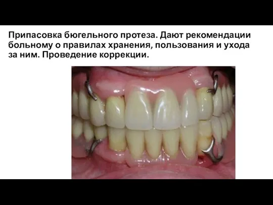 Припасовка бюгельного протеза. Дают рекомендации больному о правилах хранения, пользования и ухода за ним. Проведение коррекции.