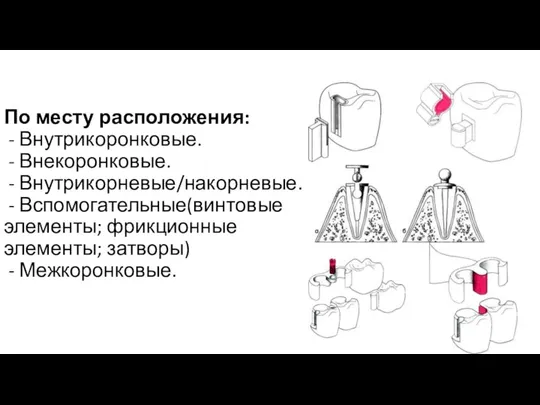 По месту расположения: - Внутрикоронковые. - Внекоронковые. - Внутрикорневые/накорневые. - Вспомогательные(винтовые