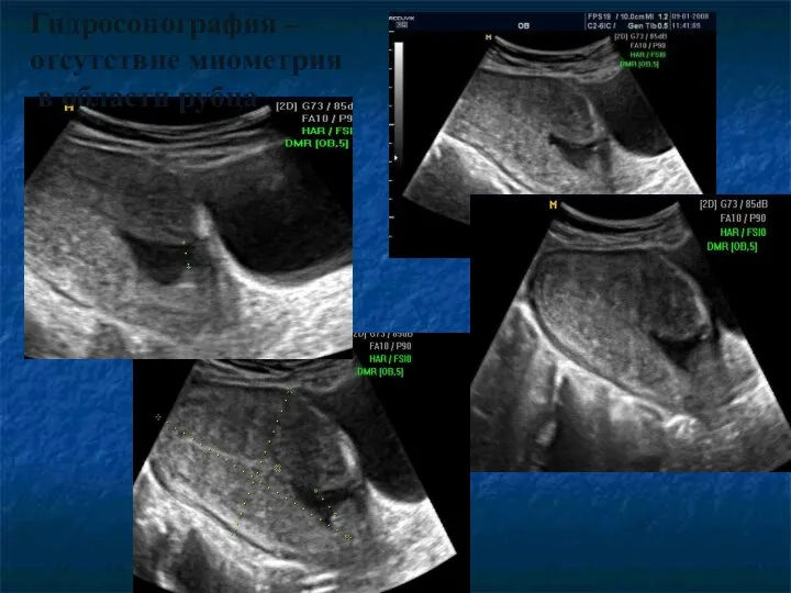 Гидросонография – отсутствие миометрия в области рубца