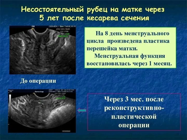 До операции Через 3 мес. после реконструктивно-пластической операции Несостоятельный рубец на