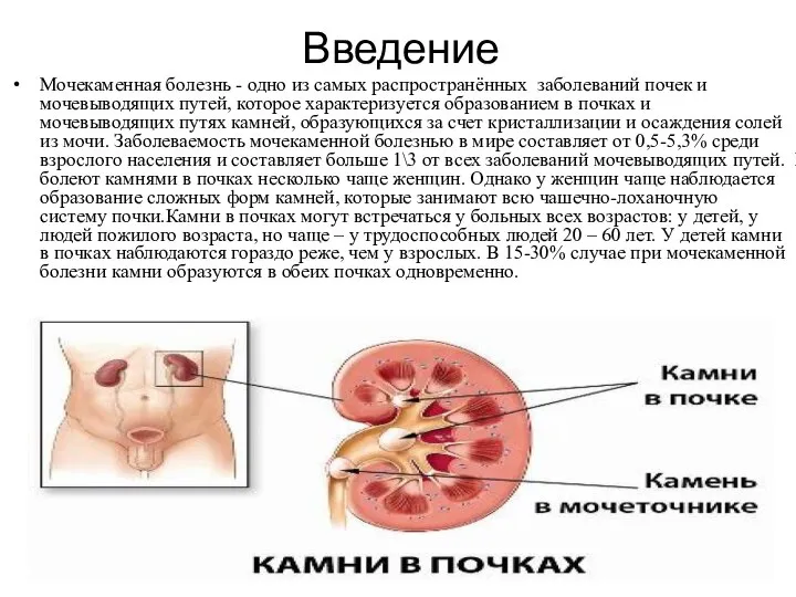 Введение Мочекаменная болезнь - одно из самых распространённых заболеваний почек и