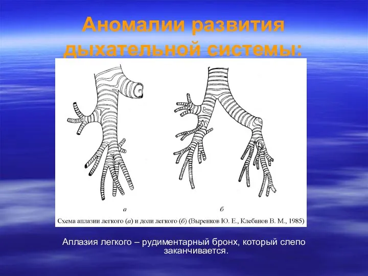 Аномалии развития дыхательной системы: Аплазия легкого – рудиментарный бронх, который слепо заканчивается.