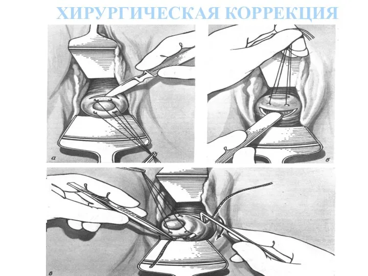 ХИРУРГИЧЕСКАЯ КОРРЕКЦИЯ ИЦН