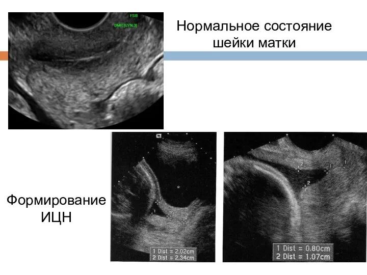 Нормальное состояние шейки матки Формирование ИЦН