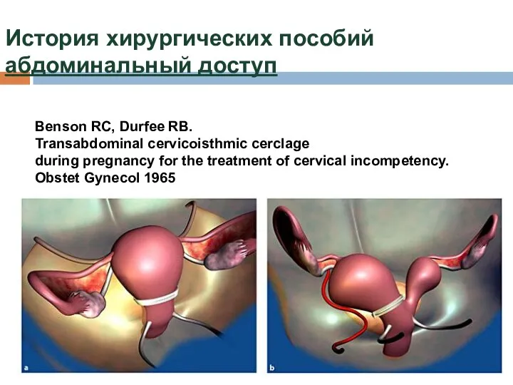 История хирургических пособий абдоминальный доступ Benson RC, Durfee RB. Transabdominal cervicoisthmic