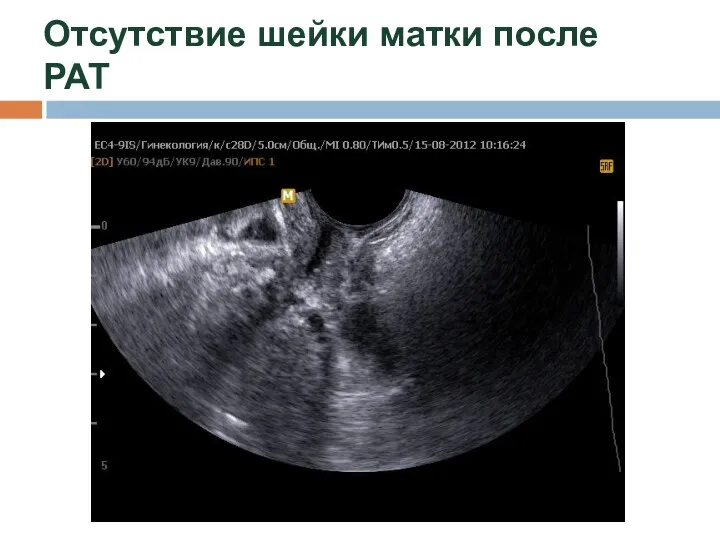 Отсутствие шейки матки после РАТ