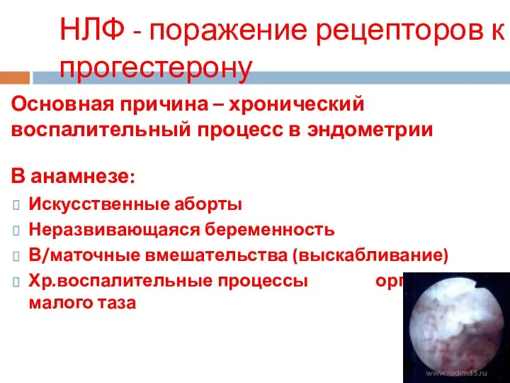 НЛФ - поражение рецепторов к прогестерону Основная причина – хронический воспалительный